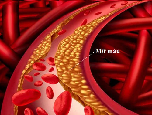 Bệnh mỡ trong máu