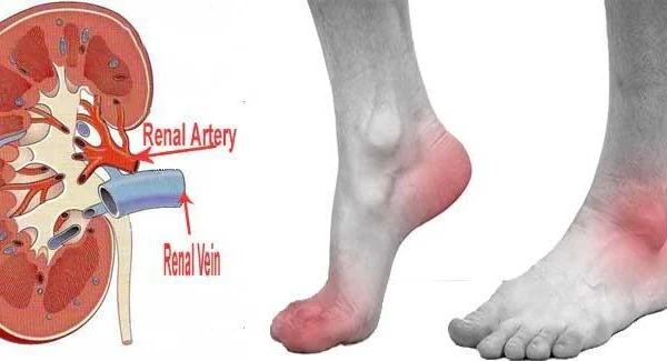 Người bị suy thận, bệnh gout